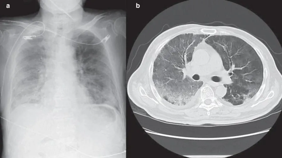 ચીનમાં કોરોના દર્દીઓના ફેફસા સફેળ થઇ રહ્યા છે, શું વુહાનવાળા વેરિયન્ટની વાપસી?