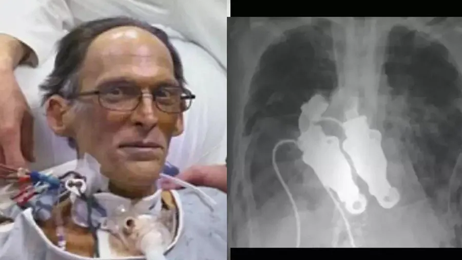 જીવનના બાકી હતા માત્ર 12 કલાક, જીવ બચાવવા ડૉક્ટરોએ હૃદય બહાર કાઢ્યું, તો પણ..