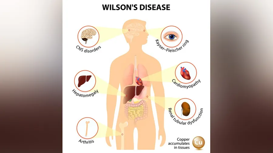 વિલ્સન રોગ જ્યારે થાય છે ત્યારે શરીર આપે છે આવા સંકેતો, જીવલેણ છે આ રોગ