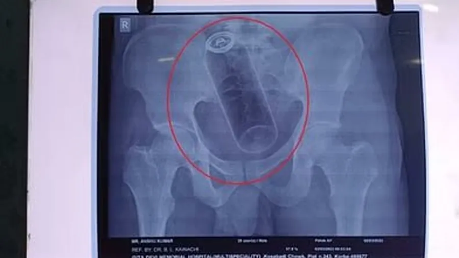 યુવકે ગુદામાર્ગથી બોડી સ્પ્રેની બોટલ નાંખી, પેટમાં ફસાઇ ગઈ, બદનામીના ડરે....