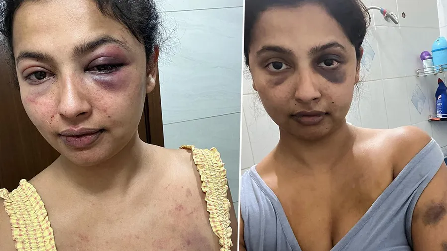 સૂજી ગયેલી આંખો, શરીરે ઉઝરડા, Ex બોયફ્રેન્ડે અભિનેત્રીને મારી,ચહેરો ઓળખી ન શકાયો