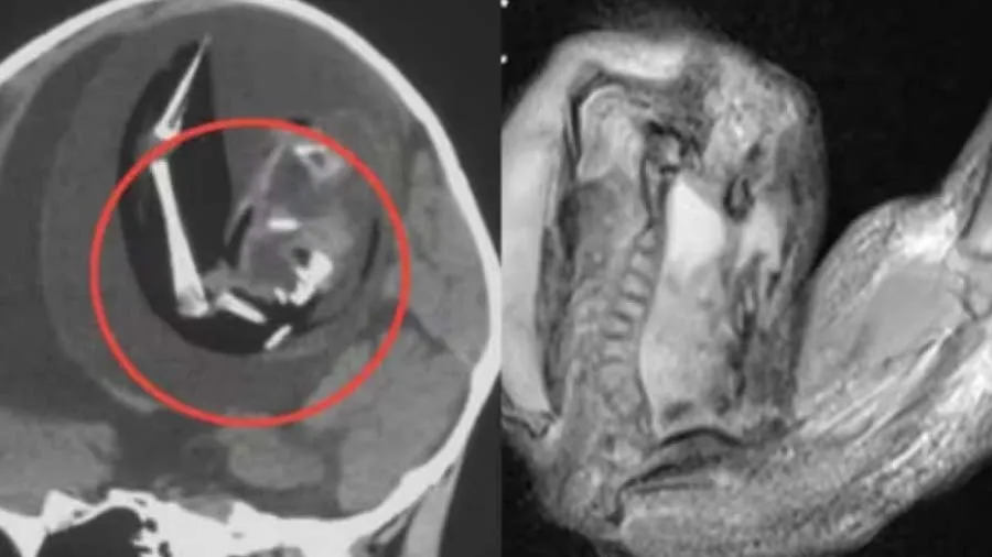 એક વર્ષની બાળકીના મગજમાં વધી રહ્યું હતું ભ્રૂણ, ડૉક્ટર પણ આશ્ચર્યમાં