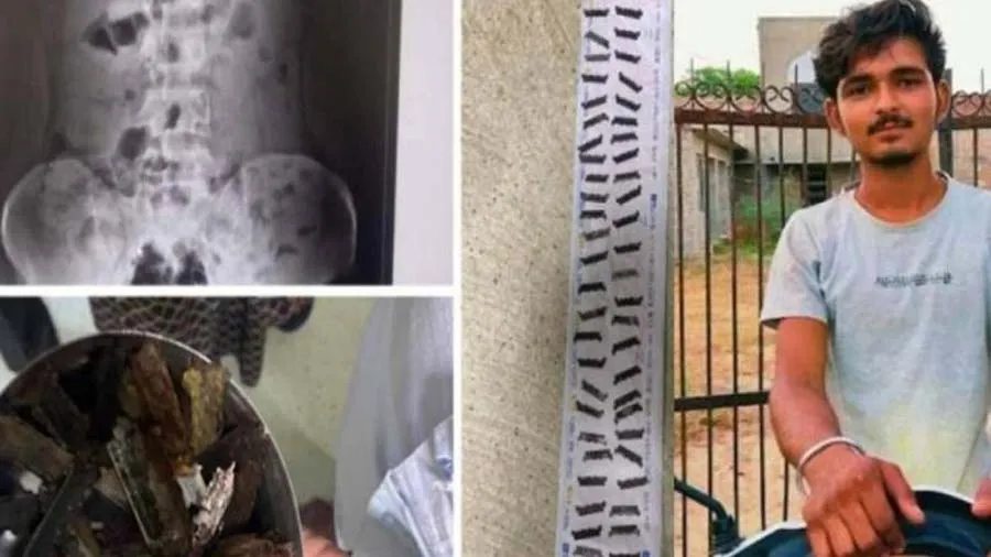 રાજસ્થાની વ્યક્તિને થતી હતી લોહીની ઉલટી, ડૉક્ટરોએ પેટમાંથી કાઢી 56 રેઝર બ્લેડ