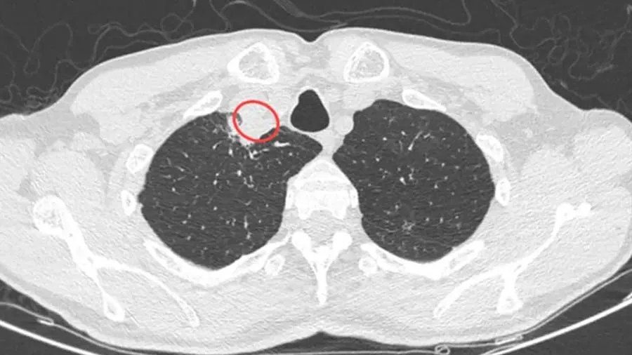 છોડથી સંક્રમિત થયો વ્યક્તિ, દુનિયાનો એવો પહેલો કેસ, જાણો શું હોય છે આ બીમારી