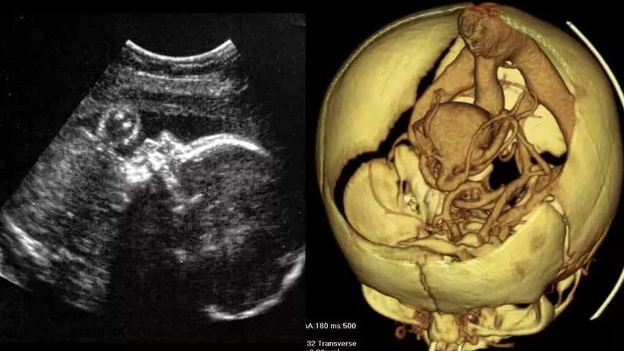 પહેલી વખત ગર્ભમાં કરવામાં આવી ભ્રૂણની બ્રેન સર્જરી, ખતરનાક બીમારીની સફળ સારવાર