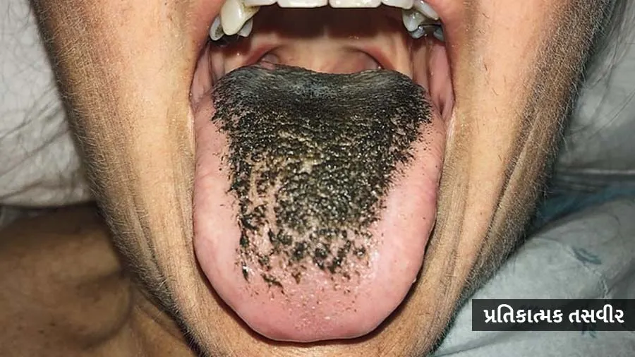 એક મહિલાની જીભ પર વાળ ઉગ્યા, ડોક્ટરો જોઇને ચોંકી ઉઠ્યા