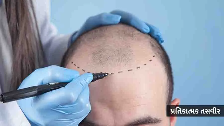 સુરતમાં હેર ટ્રાન્સપ્લાન્ટની ટ્રીટમેન્ટ નિષ્ફળ જતા મુદ્દો કોર્ટમાં, જાણો ચુકાદો