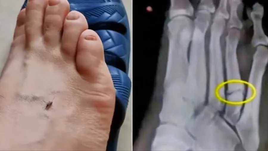 મચ્છર સામે બદલો લેવો પડ્યો ભારે, વીડિયો જોઇ તમે પણ કહેશો આ કેવી મૂર્ખતા!