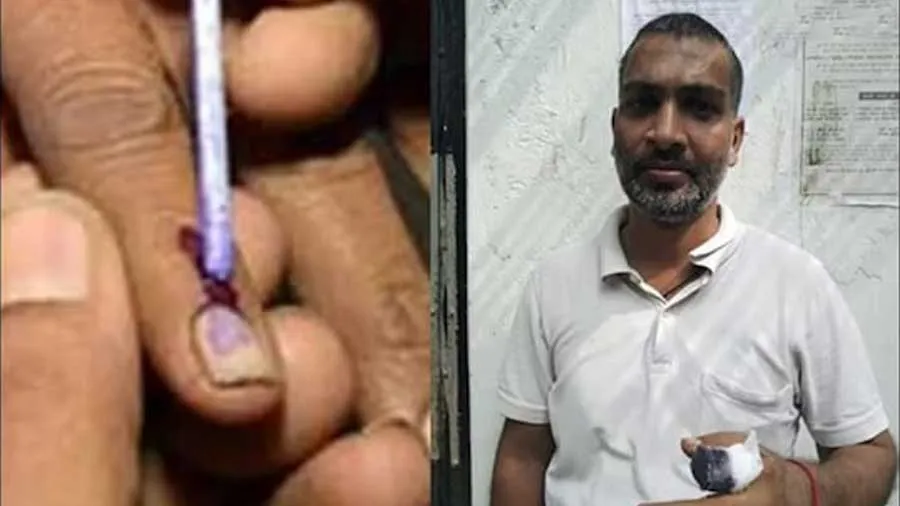 મતદાન પછી લાગેલી ઈંકથી ઈન્ફેક્શન થતા વ્યક્તિએ 2 આંગળીઓ ગુમાવી