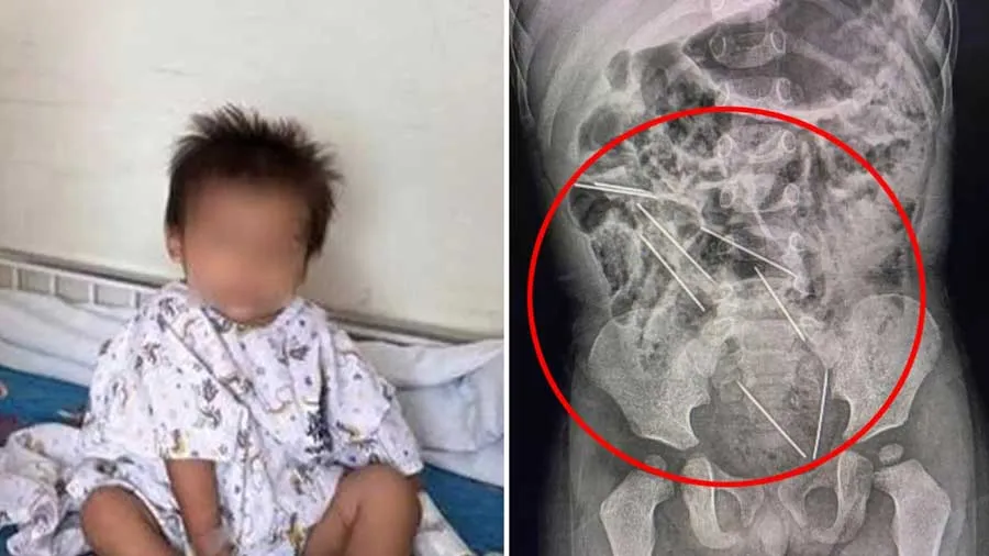 2 વર્ષનો બાળક 8 ઈન્જેક્શનની સોય ગળી ગયો, માતાએ જણાવ્યું કેવી રીતે બની આ ઘટના