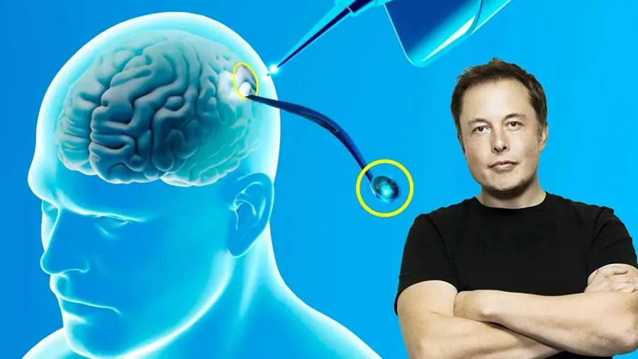 એલન મસ્ક હવે માણસોના મગજમાં ચિપ લગાવશે, હ્યુમન ટ્રાયલ માટે મંજૂરી મળી ગઇ