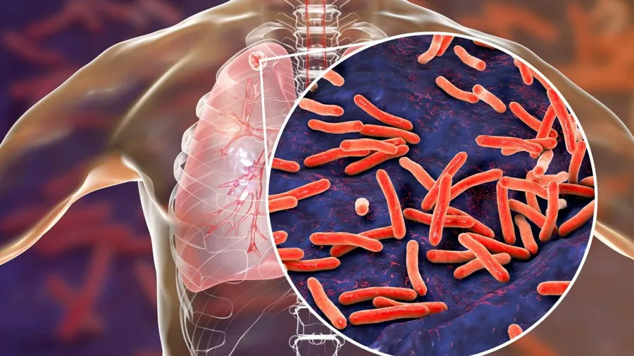 40 ટકા ભારતીયોમાં TBના લક્ષણ, ઓળખ કરવામાં મોડું થવું જીવલેણ: એક્સપર્ટ