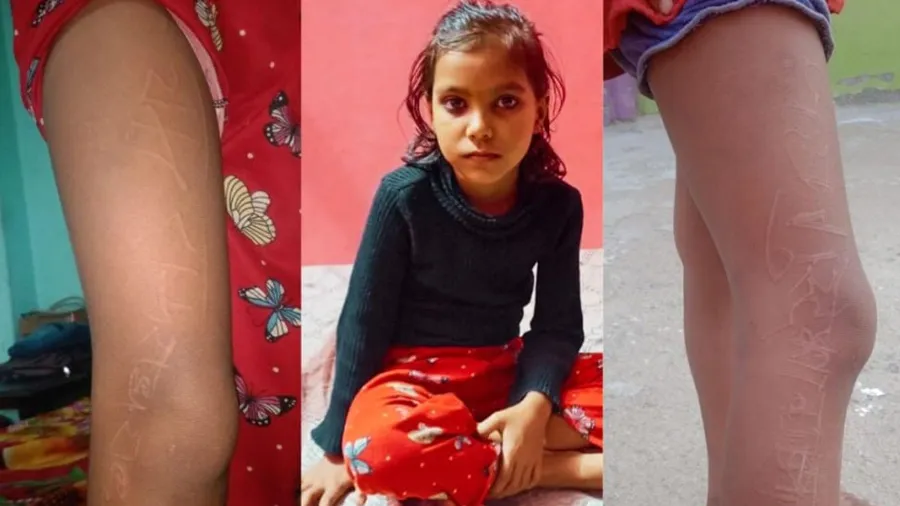 બાળકીના શરીર પર રામ-રામ અને રાધે-રાધે શબ્દ ઉપસી આવ્યા, ડૉક્ટરો પણ હેરાન