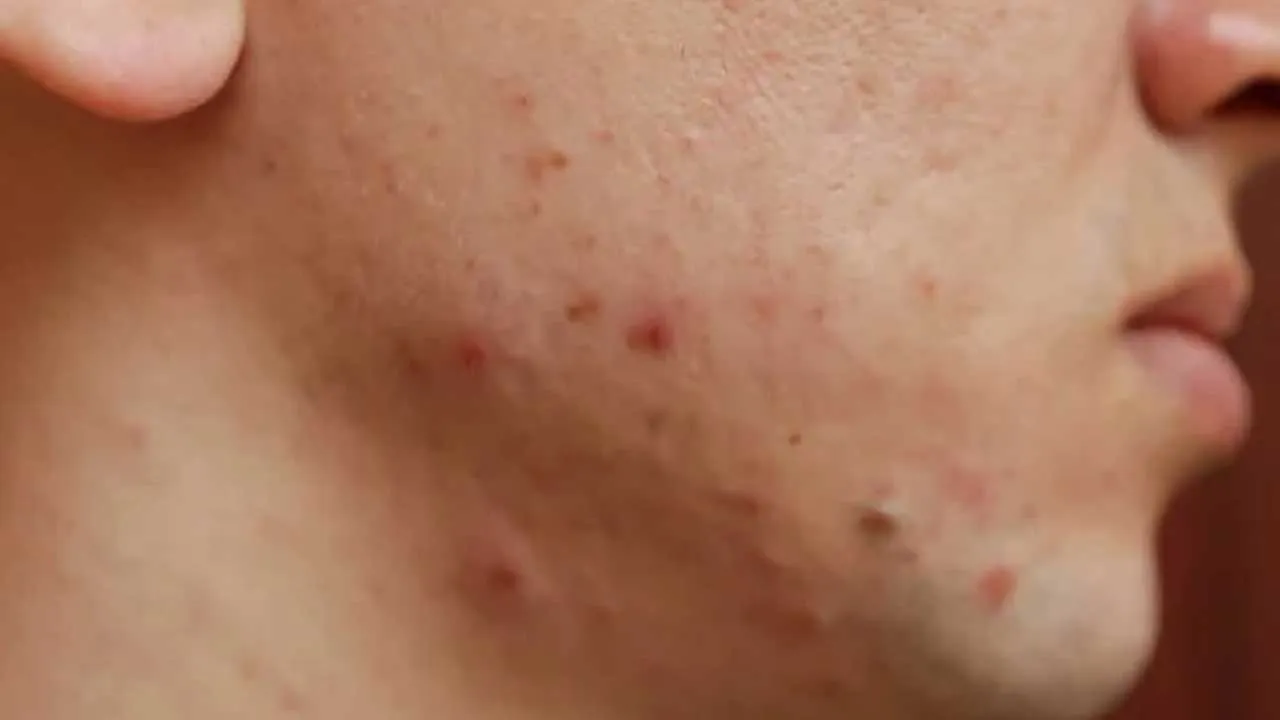 pimple