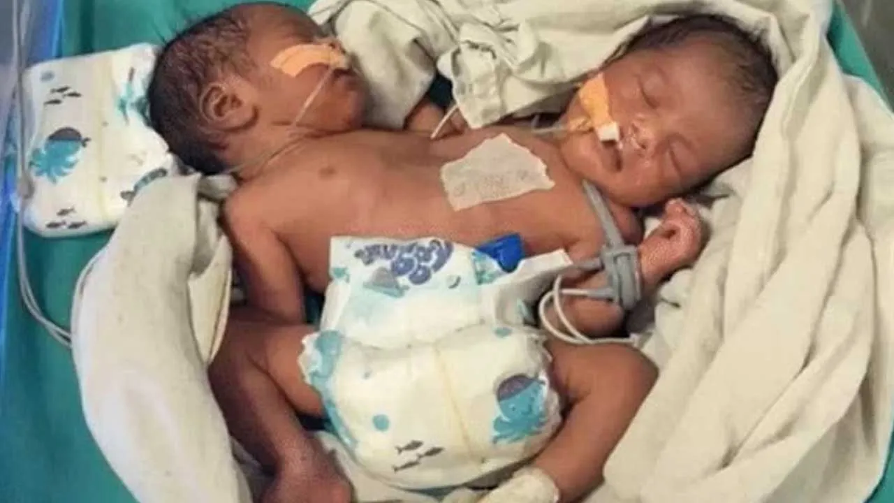 2 હૃદય, 2 માથા અને 4 હાથ સાથે જન્મી બાળકી, બંને જ ધબકી રહ્યા છે; ડૉકટરોએ જણાવ્યું તેનું સાયન્સ