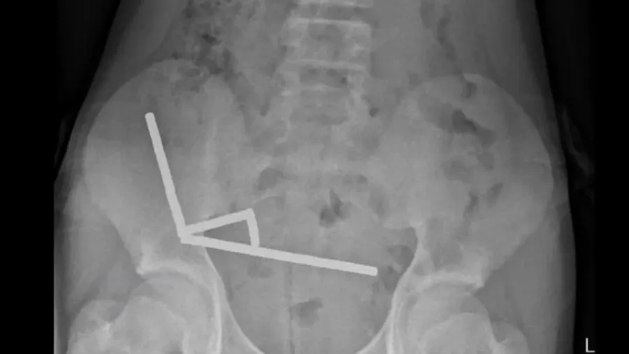 પેટ દર્દથી પીડાતા છોકરાએ ડૉક્ટરને કહ્યું, તે ચાર દિવસ પહેલા 200 ચુંબક ગળી ગયો હતો!