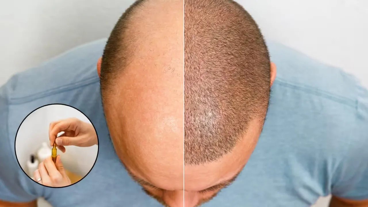 તાઇવાનના વૈજ્ઞાનિકોએ એવું સીરમ બનાવ્યું જેનાથી 20 જ દિવસમાં માથા પર કાયમી વાળ આવી જશે