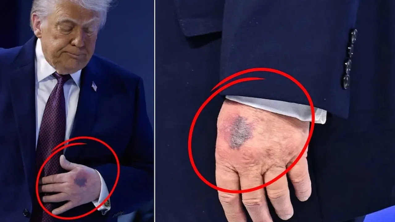 રાષ્ટ્રપતિ ટ્રમ્પના હાથ પર આ કેવો ડાઘ? જ્યારે સવાલ પૂછવામાં આવ્યો તો મળ્યો આ જવાબ