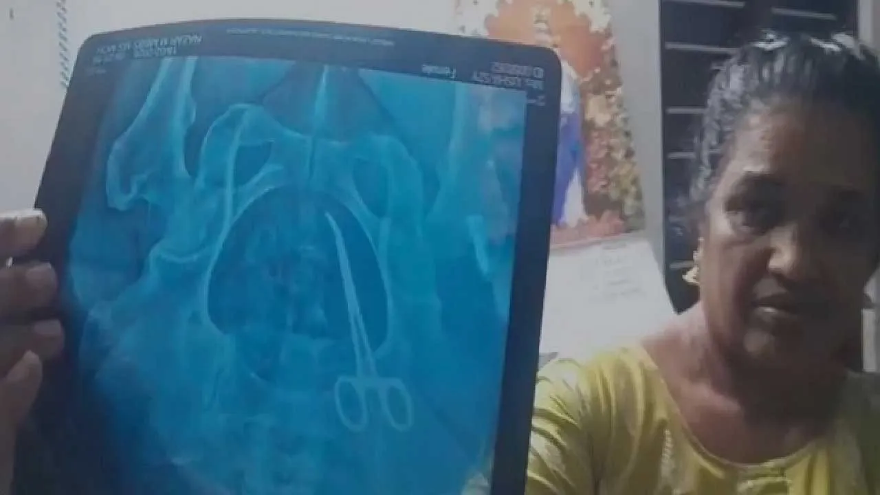 મહિલાના પેટમાંથી નીકળી સર્જિકલ કાતર; 5 વર્ષ અગાઉ થયેલી સર્જરીમાં ડૉક્ટરો ભૂલી ગયેલા