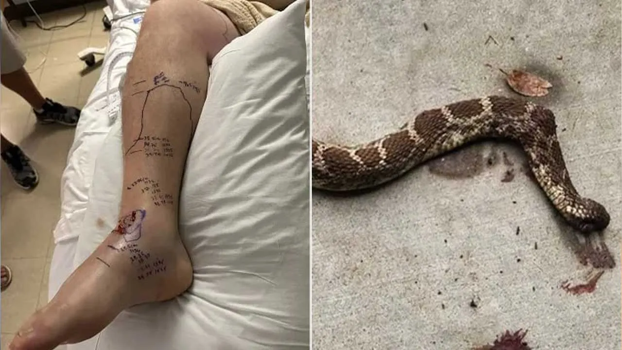 Man Bitten-Rattlesnake