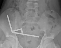 પેટ દર્દથી પીડાતા છોકરાએ ડૉક્ટરને કહ્યું, તે ચાર દિવસ પહેલા 200 ચુંબક ગળી ગયો હતો!