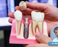 પડી ગયેલો માત્ર એક દાંત પણ તમને મોટા ખર્ચામાં ઉતારી શકે છે