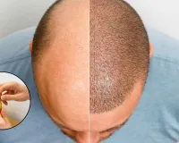 તાઇવાનના વૈજ્ઞાનિકોએ એવું સીરમ બનાવ્યું જેનાથી 20 જ દિવસમાં માથા પર કાયમી વાળ આવી જશે