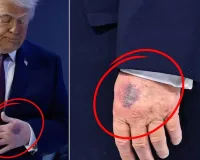 રાષ્ટ્રપતિ ટ્રમ્પના હાથ પર આ કેવો ડાઘ? જ્યારે સવાલ પૂછવામાં આવ્યો તો મળ્યો આ જવાબ