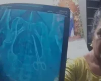 મહિલાના પેટમાંથી નીકળી સર્જિકલ કાતર; 5 વર્ષ અગાઉ થયેલી સર્જરીમાં ડૉક્ટરો ભૂલી ગયેલા