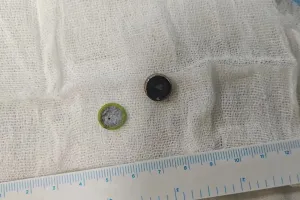 માતા-પિતા માટે લાલબત્તી સમાન કિસ્સો, 5 મહિનાના બાળકે રમતા-રમતા ગળી લીધો હતો બટન સેલ, પછી...